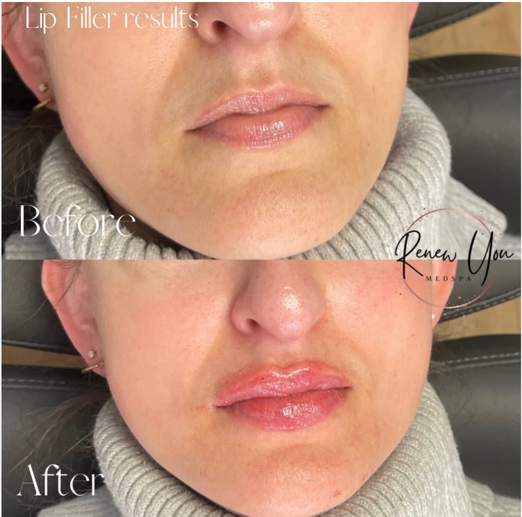 Before and After Image: Lip Filler - right-front-oblique