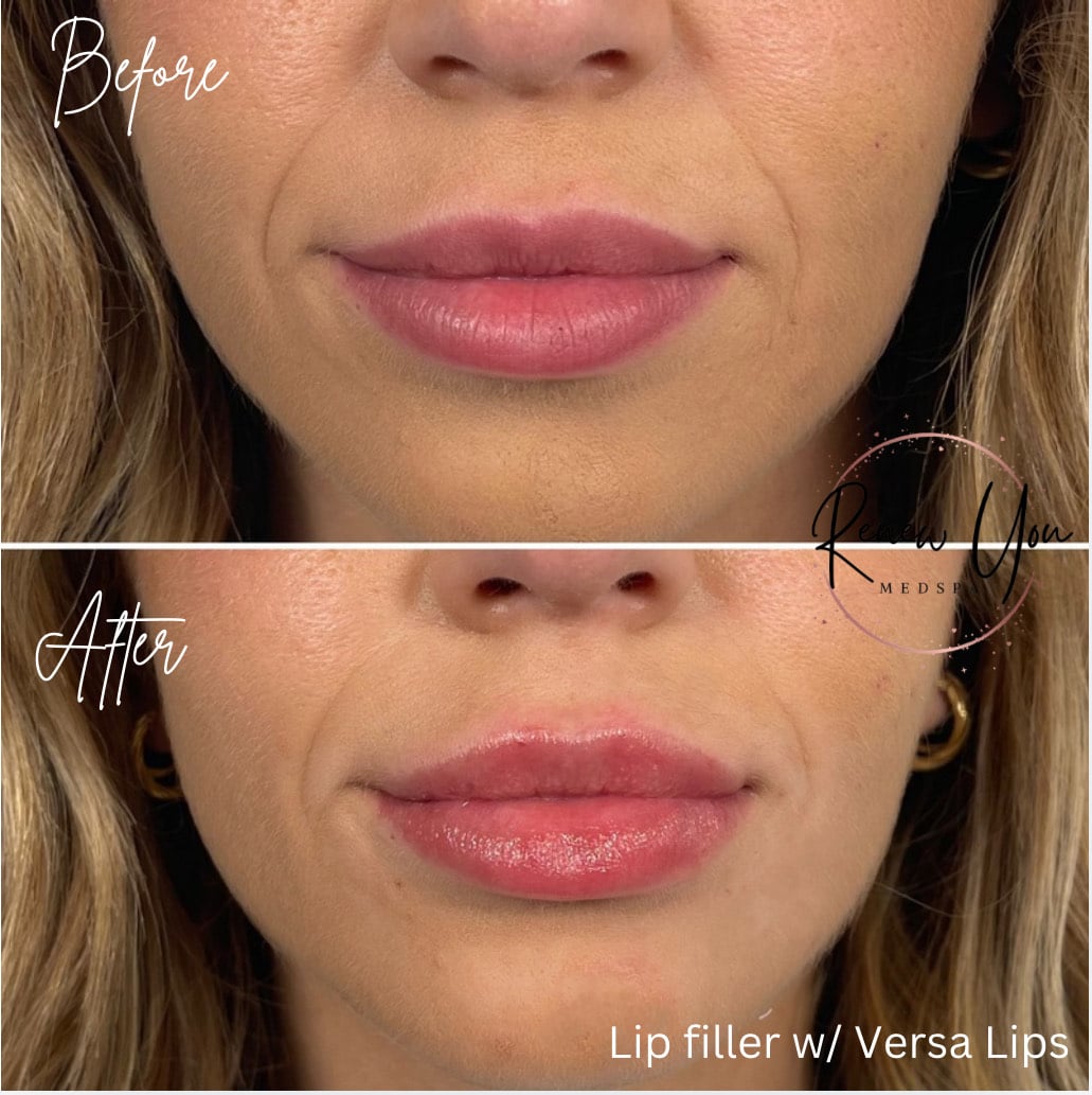 Before and After Image: Lip Filler with Versa Lips - front