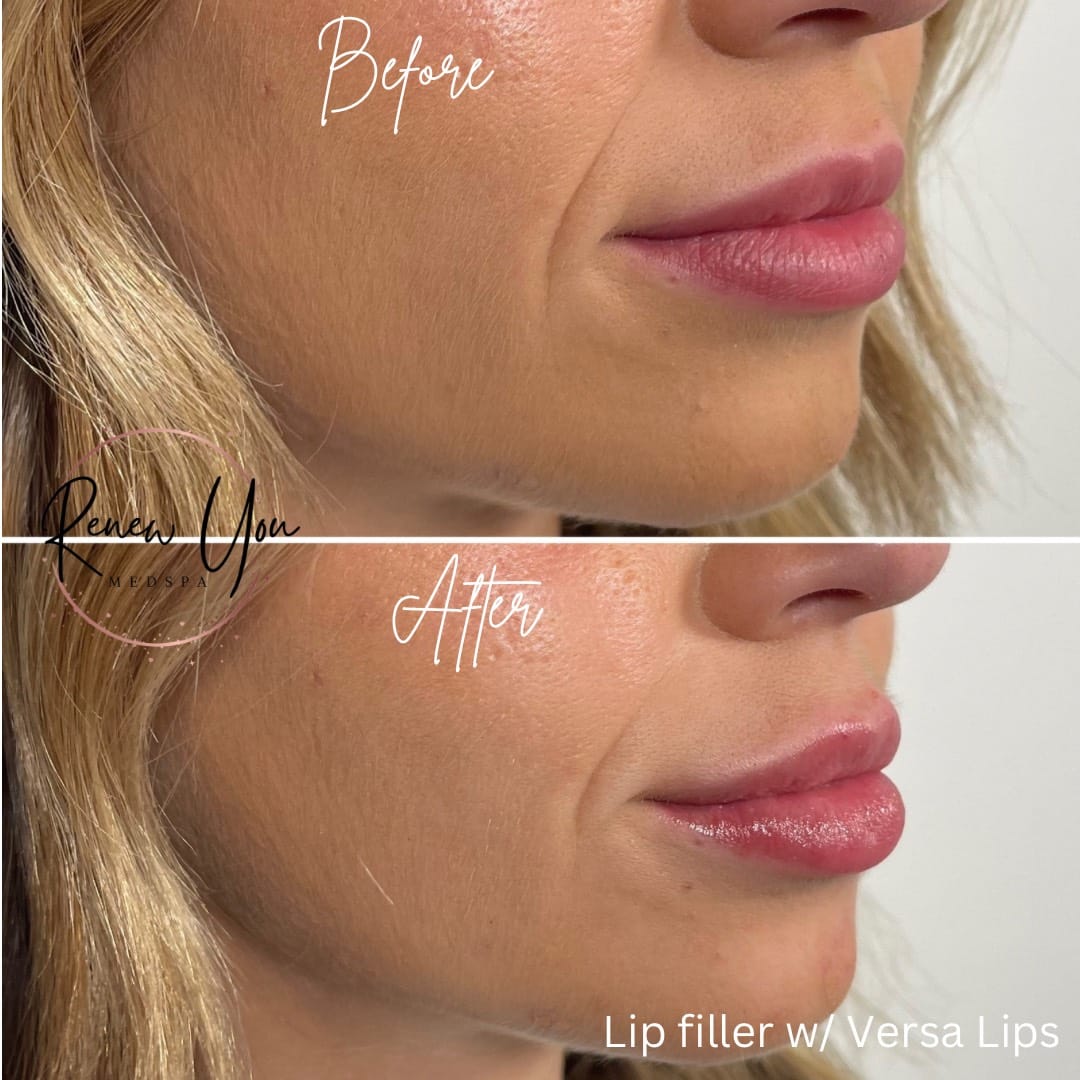 Before and After Image: Lip Filler with Versa Lips - right-front-oblique