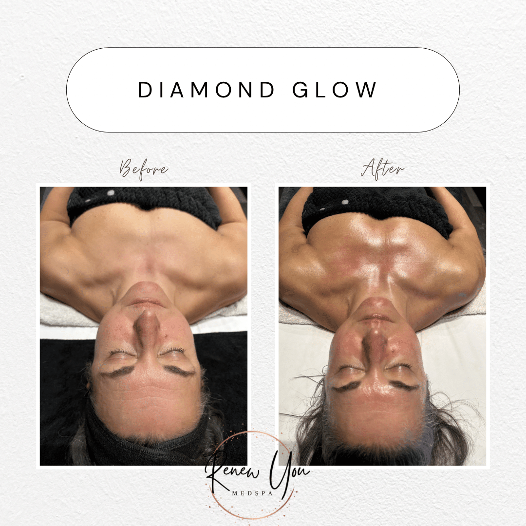 Before and After Image: Diamond Glow - front