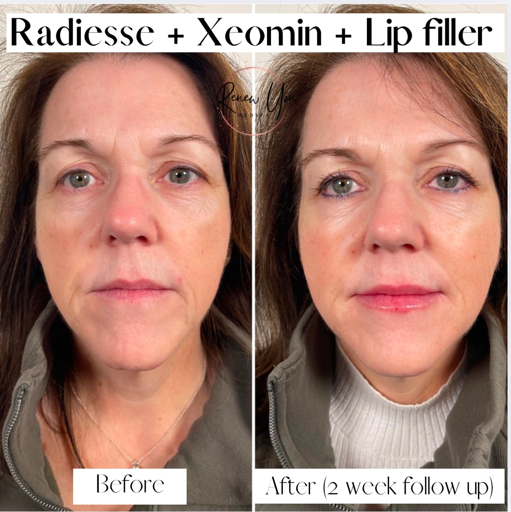 Before and After Image: Radiesse/Xeomin/Lip Filler - front