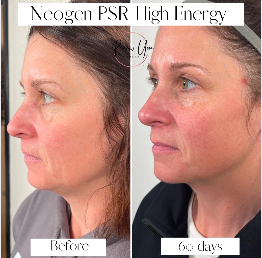 Before and After Image: Neogen High Energy - left-front-oblique
