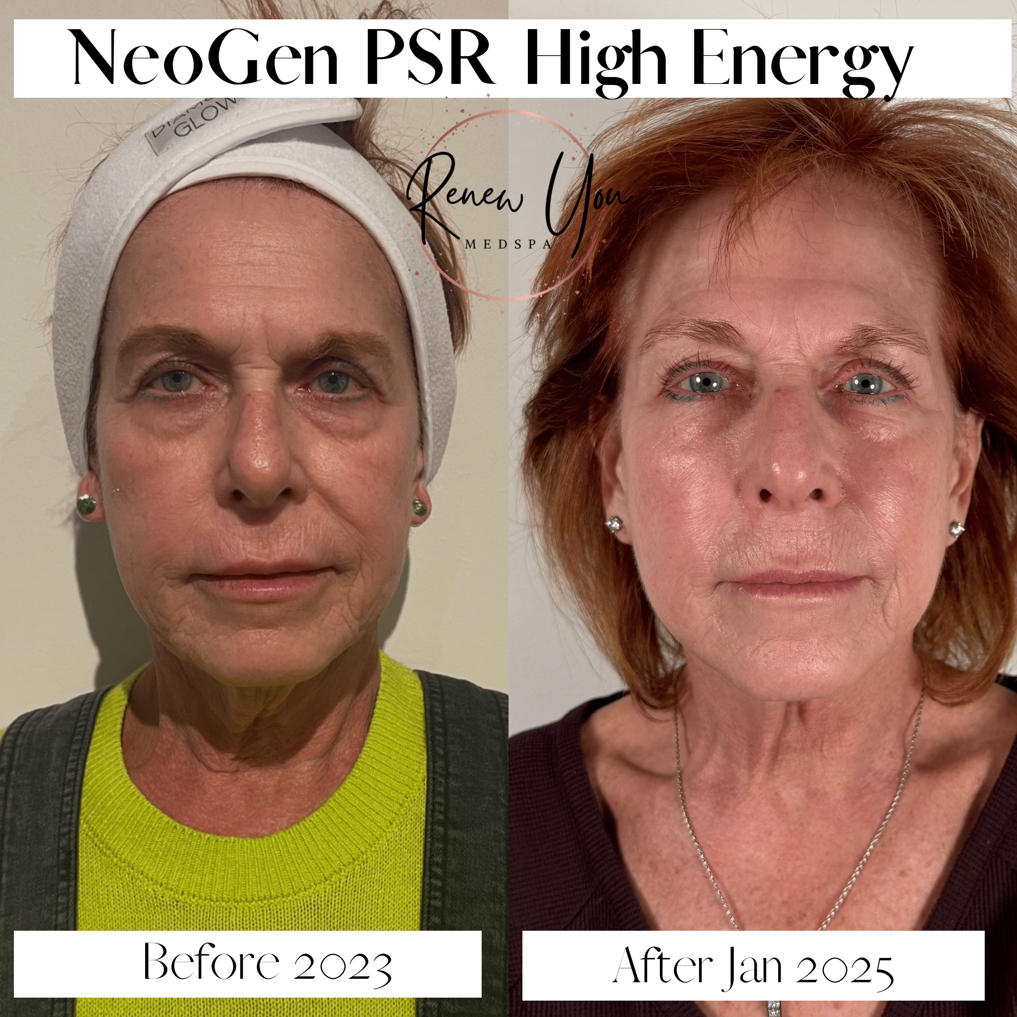 Before and After Image: Neogen PSR - front