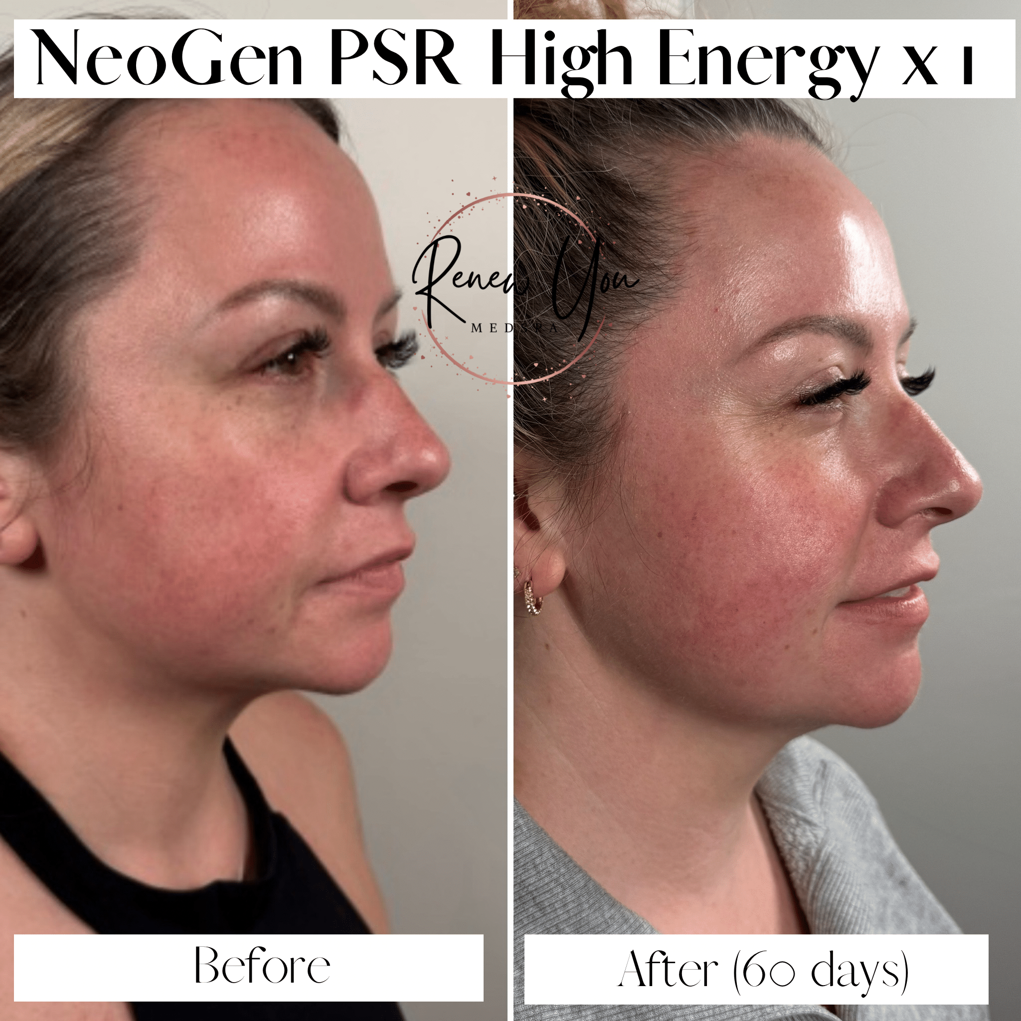 Before and After Image: Neogen PSR - right-front-oblique