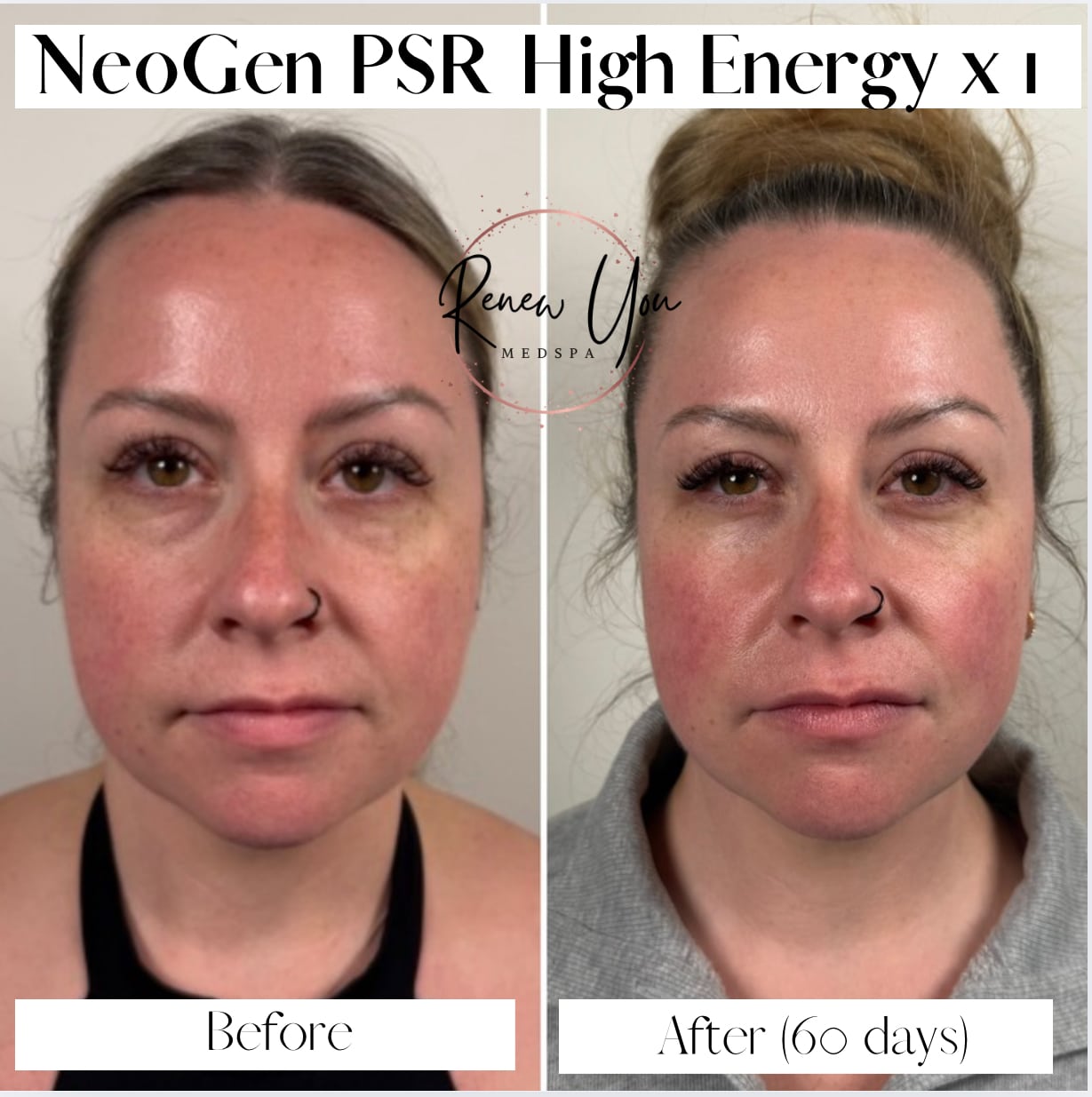 Before and After Image: Neogen PSR - front
