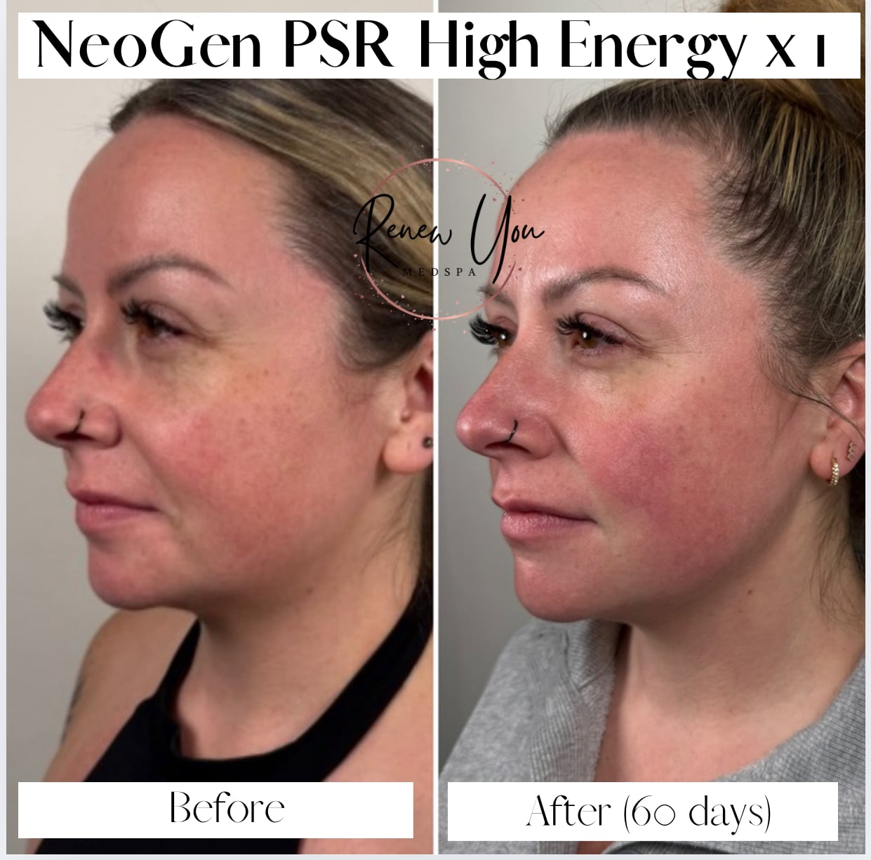Before and After Image: Neogen PSR - left-front-oblique